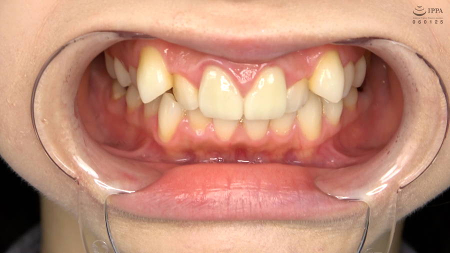 【HD】【歯・口内】大人気美女ことねチャンのマウスオープナーを付けて歯観察・口内・のどちんこ・舌ベロ観察!ことね　サンプル画像02