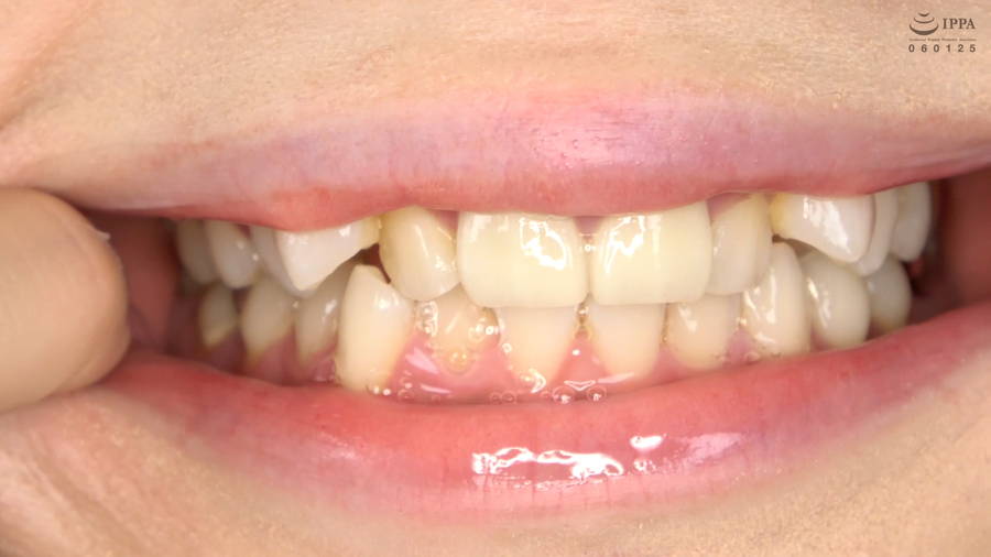 【HD】【歯・口内】大人気美女ことねチャンのマウスオープナーを付けて歯観察・口内・のどちんこ・舌ベロ観察!ことね　サンプル画像08