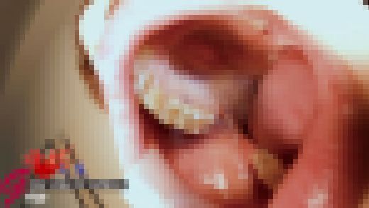 元歯科衛生士りんの銀歯を白に変えた口腔＆51mm美麗舌接写鑑賞　サンプル画像3