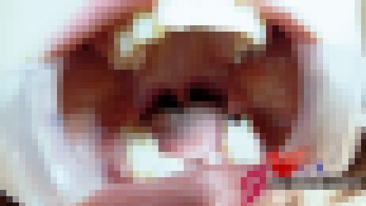 優しいエロエロOLカノン開口器が入らない!?小さめ口腔内銀歯３本接写　サンプル画像3