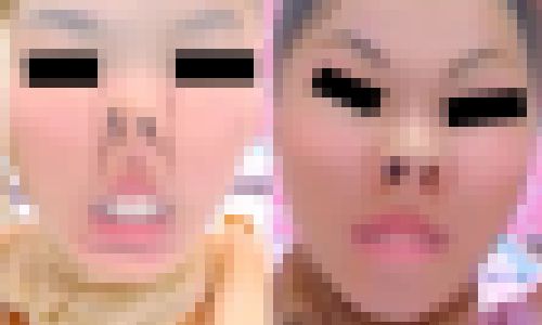 プレミア★ノーズＸＸ　理想の美鼻美顔 サンプル画像