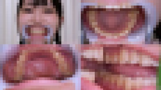 【歯フェチ】天美めあちゃんの歯を観察しました！　サンプル画像1