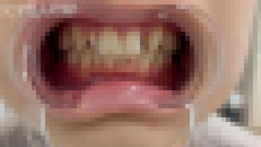 【素人・口腔フェチ】これが見れるのは奇跡です。金歯の20歳を余すとこなく完全収録。　サンプル画像1