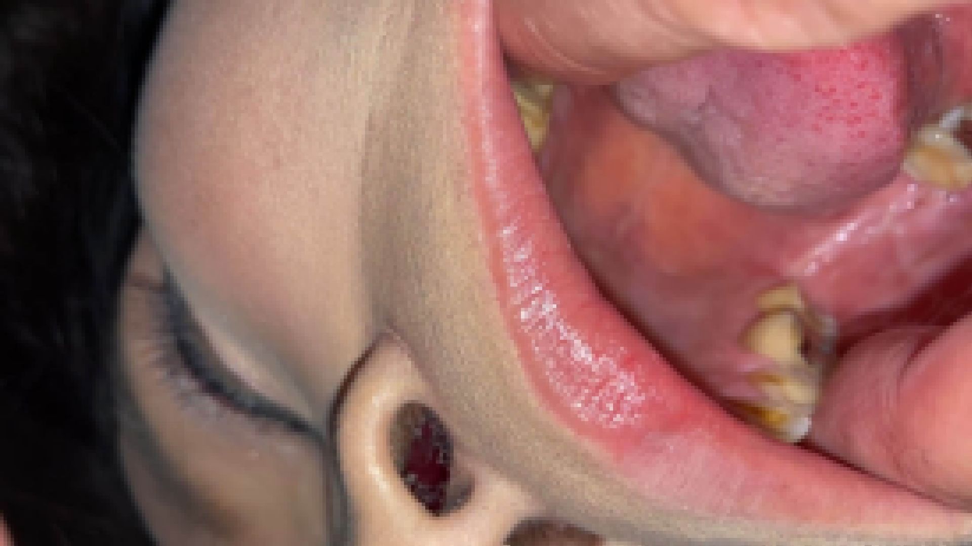 美魔女探訪・熟歯としか言いようのない茶歯＆カブセ ツバキ② KITR00284 サンプル画像