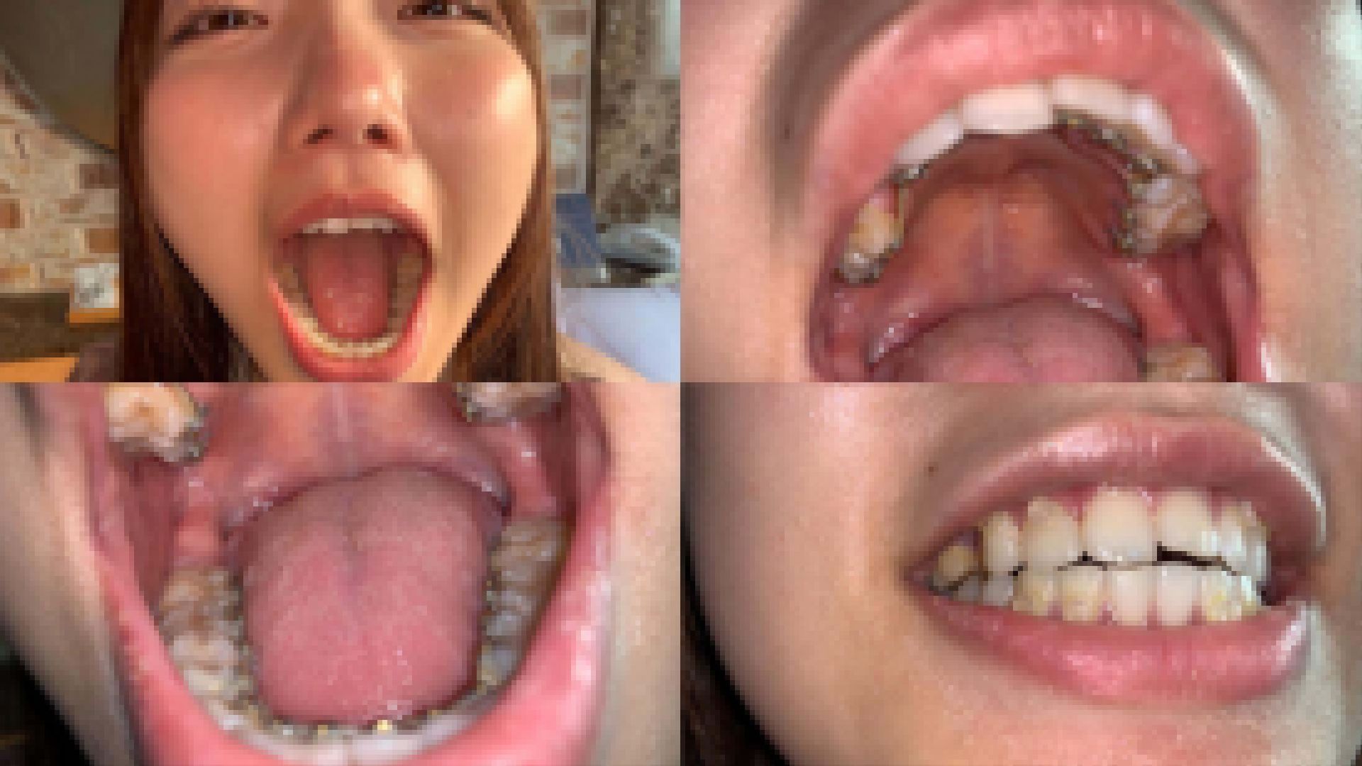 歯姫 45人目 [FBOM-00107] サンプル画像